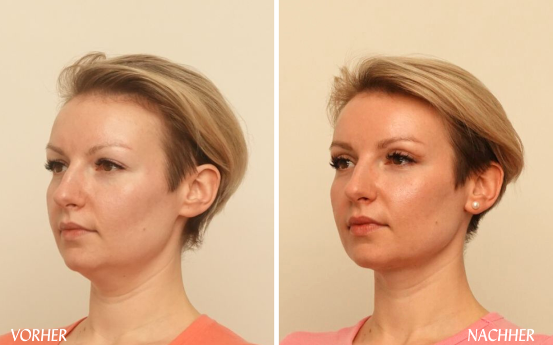 Der neue Trend: Lower-Facelift